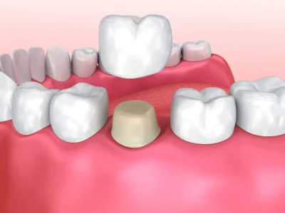 DentalCrown900x600.jpg