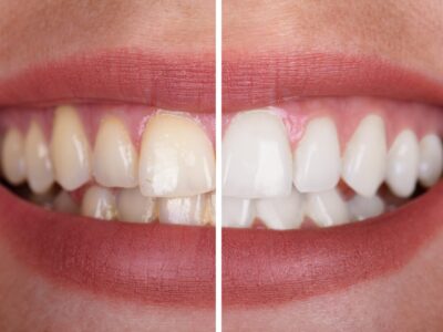 teeth_dental_implants_antalya_aesthetic_surgery_plastic_kaleici_zirconia_crown